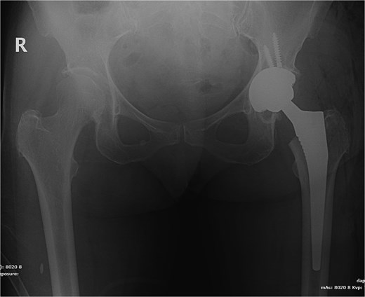 X-ray pelvis showing left total hip replacement with hardware in adequate position.