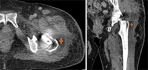 CT of the hip with contrast showed peripherally enhancing deep fluid collection (marked with star) containing gas pockets abutting the left proximal femur extending to the subcutaneous tissue and the gluteus medius muscles and measuring 7.2 × 6.6 × 14 cm with overlying skin thickening and fat stranding.