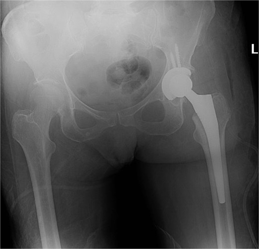 X-ray of the pelvis showing metallic hardware in good position.
