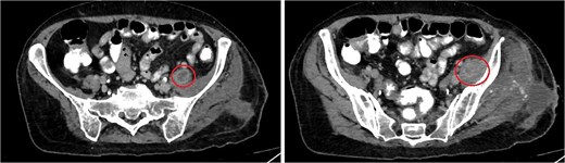CT abdomen/pelvis showing rim enhancing fluid collection (marked with circle) in the left psoas muscle (left image) with extension to the left iliacus (right image) measuring 8.7 × 2 × 1.5 cm, suggestive of abscess formation.
