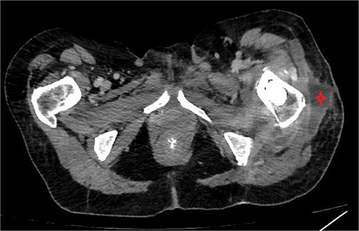 CT abdomen/pelvis showing subcutaneous collection at the upper lateral aspect of the thigh in the vicinity of the left proximal femur.