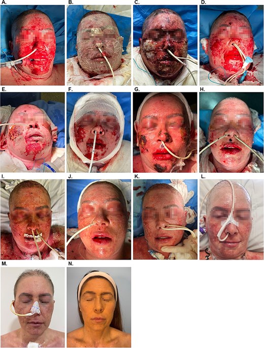 Representative images of the treatment progression. (A) Day 1 on admission to the ICU. (B) Day 2, post application of antimicrobial OFM. (C) Day 4, post dressing removal. (D) Day 8 on removal of the dressing and post light debridement. (E) Day 10. (F) Day 13, post light debridement. (G) Day 17. (H) Day 19. (I) Day 22. (J) Day 25. (K) Day 31. (L) Day 38. (M) Day 66. (N) Six month follow-up.