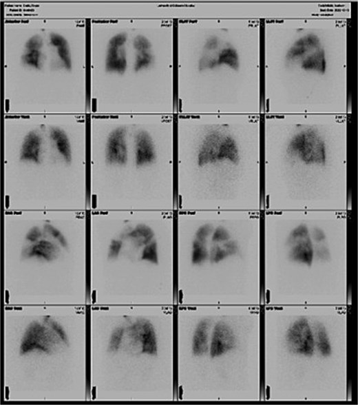 Preoperative ventilation-perfusion (V/Q) scan demonstrating bilateral segmental and subsegmental perfusion defects consistent with chronic thromboembolic pulmonary hypertension.