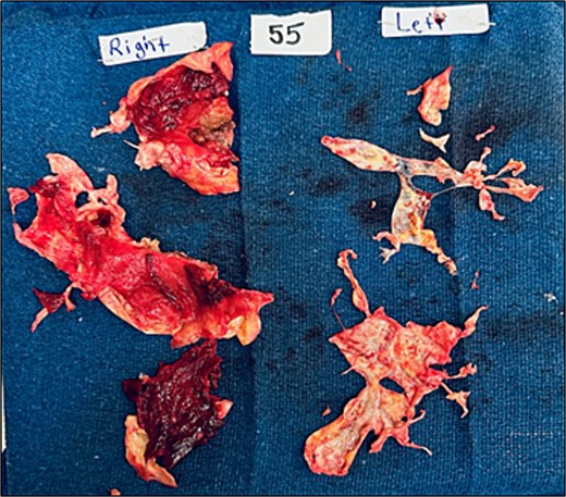 Intraoperative specimen showing large clot burden removed during bilateral pulmonary thromboendartectomy, with both subacute and chronic organized thromboembolic material evident.