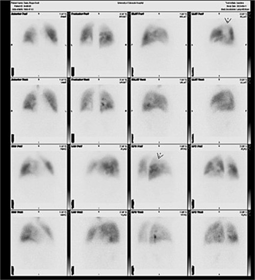Six-month postoperative V/Q scan demonstrating interval improvement in bilateral pulmonary perfusion, with homogenous distribution of radiotracer and normalization of hilar and vascular markings.