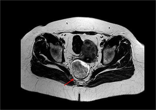 MRI of the pelvis in axial view demonstrating a solid, stenosing lesion located 27 mm from the anal verge. The lesion infiltrates the muscular layer between the 7 and 11 o’clock positions and causes changes in the intensity of the mesorectal fat without fascia involvement.