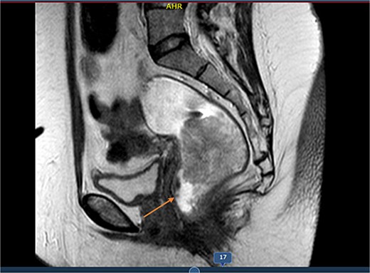 MRI sagittal view showing the longitudinal extent of the rectal lesion measuring ~73 mm in length, involving the mid-to-distal rectum, consistent with a T3N0M0 tumor staging.