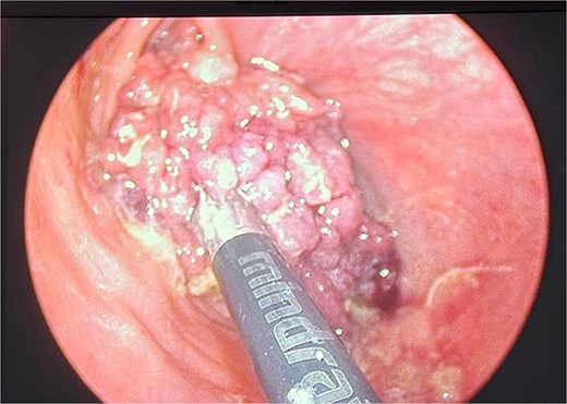 Intraoperative image during transanal minimally invasive surgery (TAMIS) showing the polypoid tumor with friable and irregular borders measuring ~5 cm. The base of the lesion is marked with a suture to guide excision.