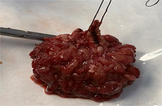 Resected specimen after TAMIS demonstrating the excised tubulovillous adenoma with clear margins, sent for histopathological evaluation.