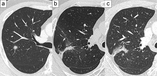 Representative images of preoperative computed tomography. Primary lung cancer at the age of 52 (a), first local recurrence at the age of 56 (b), and second local recurrence at the age of 58 (c).