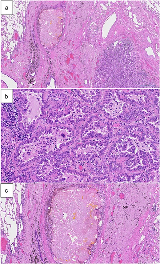 (a) Papillary adenocarcinoma, fibrosis, as well as foreign body-type giant cells and cholesterol clefts (hematoxylin and eosin staining, 2× magnification). (b) Papillary adenocarcinoma was dominantly observed (hematoxylin and eosin staining, 20× magnification). (c) Foreign body-type giant cells and cholesterol clefts were observed along with fibrosis (hematoxylin and eosin staining, 5× magnification).