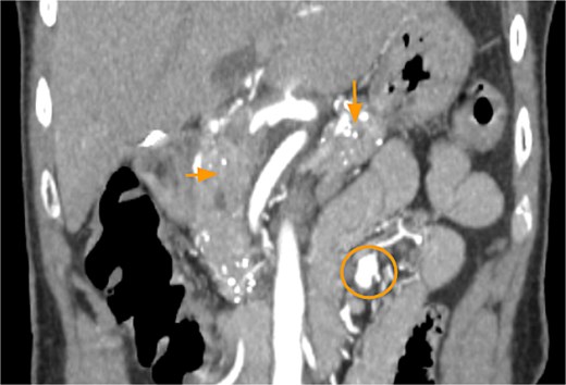 CTA abdomen and pelvis demonstrating pancreatic calcifications (arrows) and SMAP (circle).