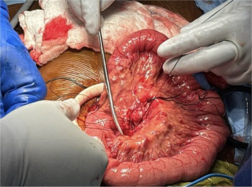 Ligation of feeder vessels to pseudoaneurysm.