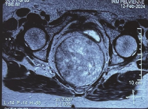 Pelvic MRI of the mass.