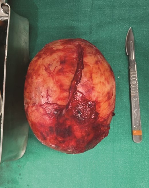 The operative specimen.