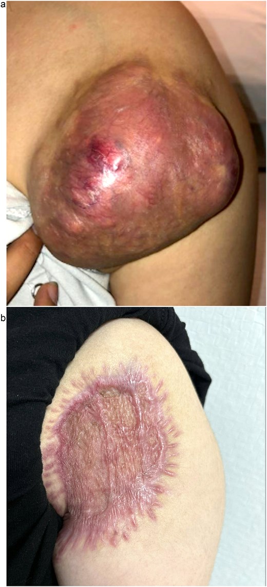 Pre-operative image (a) and image at follow-up with a healing skin graft (b) of the left anterior shoulder.