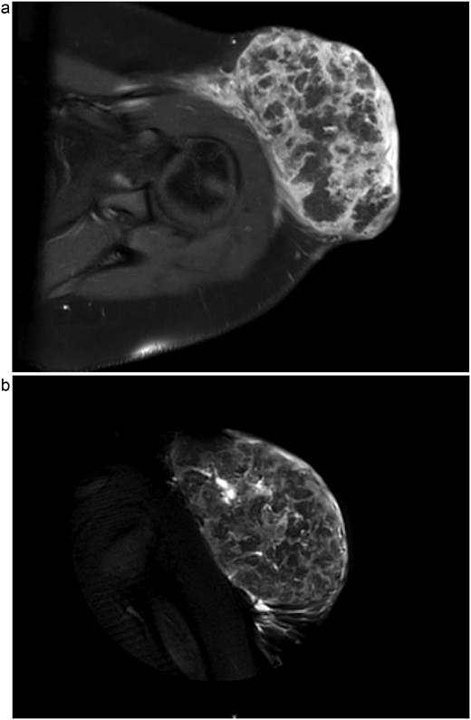 1.5 Tesla MRI with axial view (a) and coronal view (b) showing a 10.8 × 6.7 × 7.4 cm left anterolateral shoulder soft tissue mass. This is suspicious for malignancy, most likely sarcoma, due to lack of a soft tissue plane between the tumour and the deep deltoid musculature as well as enlarged axillary lymph nodes (not shown).