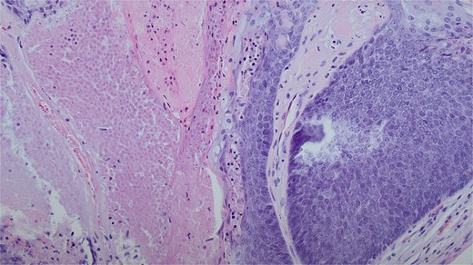 A dual cell population of basaloid cells and anucleate ghost cells with associated necrosis. This is a classic finding for a benign pilomatricoma of this size. Magnification of 20× and stained with haematoxylin and eosin.