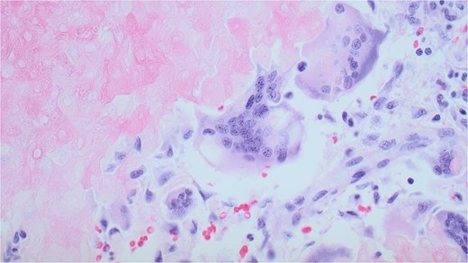A multinucleated giant cell within the pilomatricoma. Derived from macrophages, this likely developed as an immune response to the necrotic ghost cells. Pilomatricomas are dermal tumours derived from hair follicle matrix cells, which undergo abrupt keratinization leading to the formation of ghost cells. These ghost cells contain degenerated nuclear and cellular material that stimulate macrophages and their fusion into multinucleated giant cells. Magnification of 20x and stained with haematoxylin and eosin.