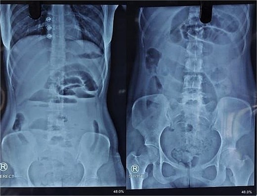 X-ray abdomen showing dilated small bowel loops with faecal loading (erect and supine).