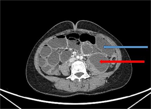 CT abdomen/pelvis with contrast, upper arrow showing dilated small bowel loops and lower arrow showing collection in left psoas muscle.