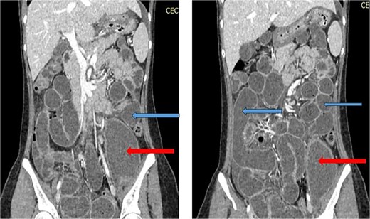 CT abdomen/pelvis with contrast, upper arrows showing dilated small bowel loops and lower arrrows showing collection in left psoas muscle.