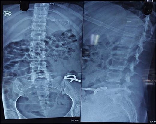X-ray abdomen showing pig tail catheter in left inguinal region and nasogastric tube in stomach (anteroposterior and lateral).