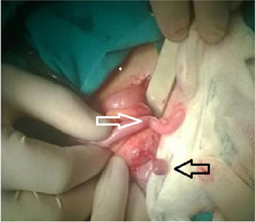Torsion of the epiploic appendix of the cecum (black arow) with a normal appendix vermiform (white arow).