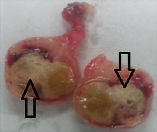 Ischemic infarct of the epiploic appendix adipose tissue (arrows).