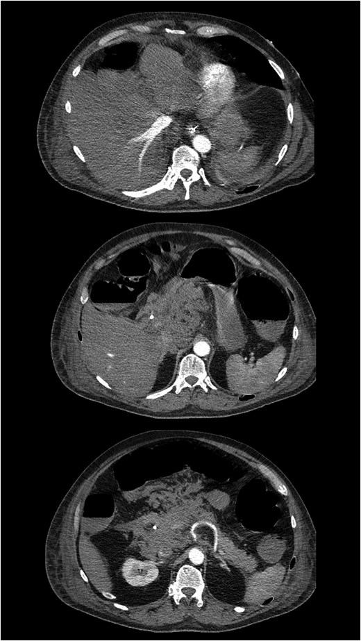 Contrast-enhanced CT demonstrating hemorrhage within the hepatoduodenal ligament and decreased arterial liver perfusion.