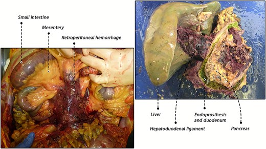 Autopsy findings. Left: in situ view of the retroperitoneal hemorrhage. Right: ex situ hepatopancreatobiliary specimen demonstrating hemorrhage within the hepatoduodenal ligament.