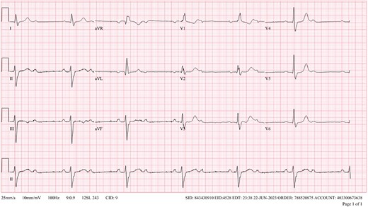 Initial ECG demonstrating bradycardia and second-degree bifascicular block and second-degree Mobitz type 2 AVB with 2:1 conduction.