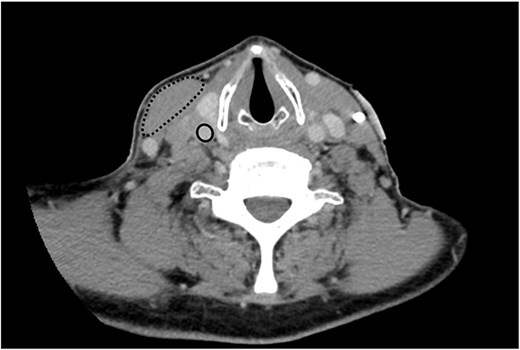 Axial plane image of contrast-enhanced CT scan demonstrating right-sided neck mass displacing the right sternocleidomastoid muscle (dashed line), occluding the right internal jugular vein (not seen) and compressing the right carotid artery (solid line) .