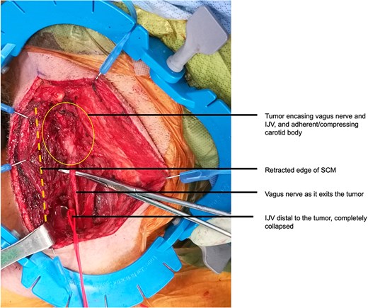 Intraoperative appearance of the tumor before debulking and resection of the right vagus nerve. IJV, internal jugular vein; SCM, sternocleidomastoid.