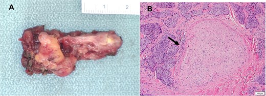 (A) Gross image of the excised portion of the vagus nerve; (B) Histopathologic image of hematoxylin and eosin-stained cross section of excised portion of vagus nerve showing squamous cell carcinoma (arrow) involving soft tissue adjacent to nerve.
