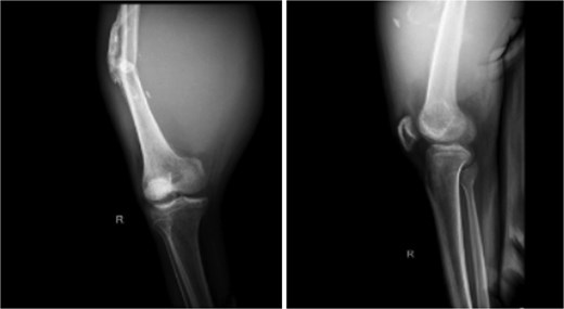 X-ray imaging of the right femur reveals a mid-shaft fracture with prominent callus formation. A soft tissue mass is observed surrounding the right femur, with no evidence of underlying bone lesions.
