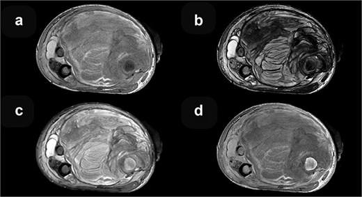 MRI axial sequences of the femur at the level of the fracture reveal a heterogeneous soft tissue mass. This mass exhibits predominantly iso-hyperintense signals on T1-weighted images (a), which, when correlated with T2-weighted images (b), are consistent with a hematoma of varying ages. The surrounding bone demonstrates normal signal intensity on T2 FS (c), and T1 contrast-enhanced (d) sequences.