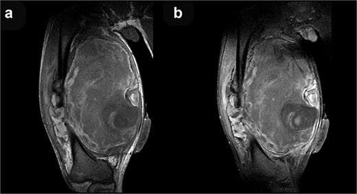 Coronal T1-weighted (a) and post-contrast T1-weighted (b) MRI sequences demonstrate no discernible contrast enhancement within the mass.