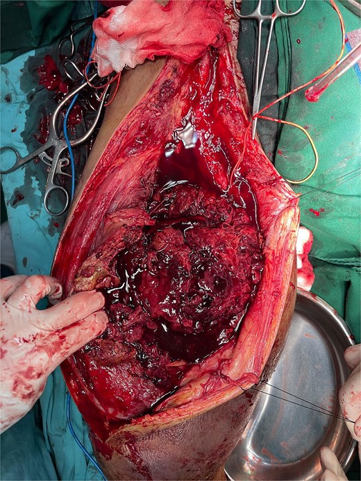 Intra operative finding.