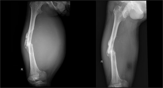 X-ray imaging post operation of the right femur reveals a mid-shaft fracture with prominent callus formation.