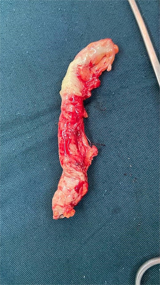 Intraoperative findings of abscessed appendicitis in a 33-week pregnant patient.