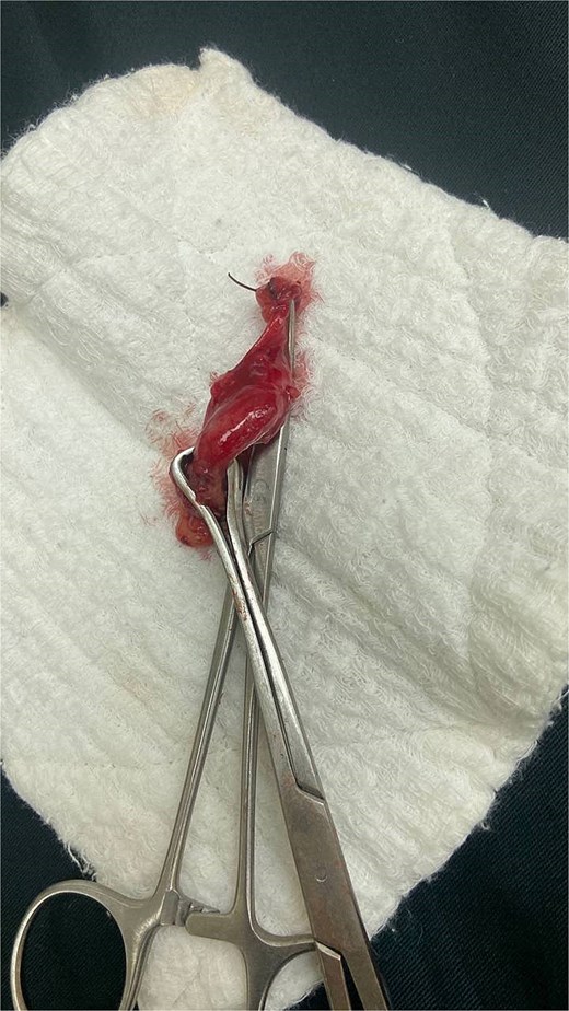 Intraoperative findings of acute appendicitis in a 28-week pregnant patient.