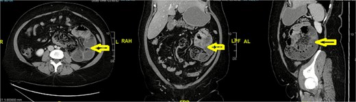 Left paraduodenal hernia (arrow).