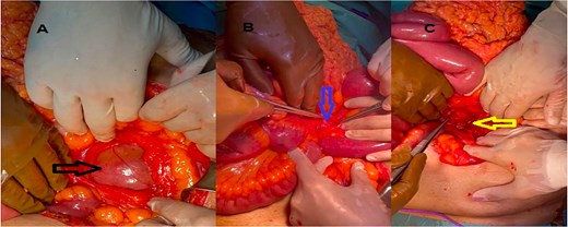 (A) Hernial sac containing bowel (black arrow), (B) IMV (blue arrow), (C) after divison of the IMV (yellow arrow).