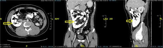 CT abdomen showed right sided paraduodenal hernia (arrow).