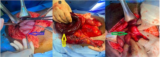 (A) Opened hernial sac with bowel content, (B) ischemic bowel, (C) Duodeno-jejunal junction (DJ) on right side.