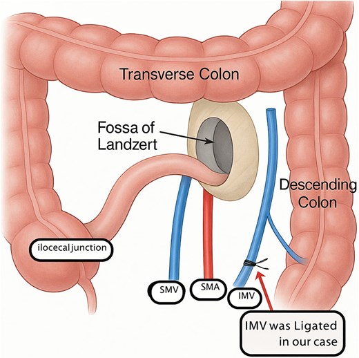 This illustration demonstrates the key anatomical relationships involved in a left paraduodenal hernia. The herniation occurs through Landzert’s fossa, a congenital peritoneal recess located posterior to the IMV and left colic artery, and lateral to the fourth portion of the duodenum. In this diagram, the jejunal loops are shown entering the fossa beneath the IMV, which forms the characteristic vascular boundary of the hernia neck. The transverse colon and descending colon outline the surrounding colonic frame, while the SMA and SMV define the central vascular axis. This configuration reflects the typical mechanism of entrapment seen in left paraduodenal hernias and is important for both radiologic recognition and safe surgical reduction.