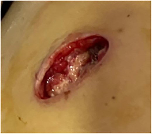 Wound dehiscence.