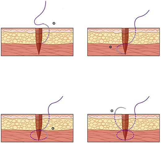 Needle insertion sequence during suturing.
