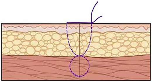 Incision condition after suturing.